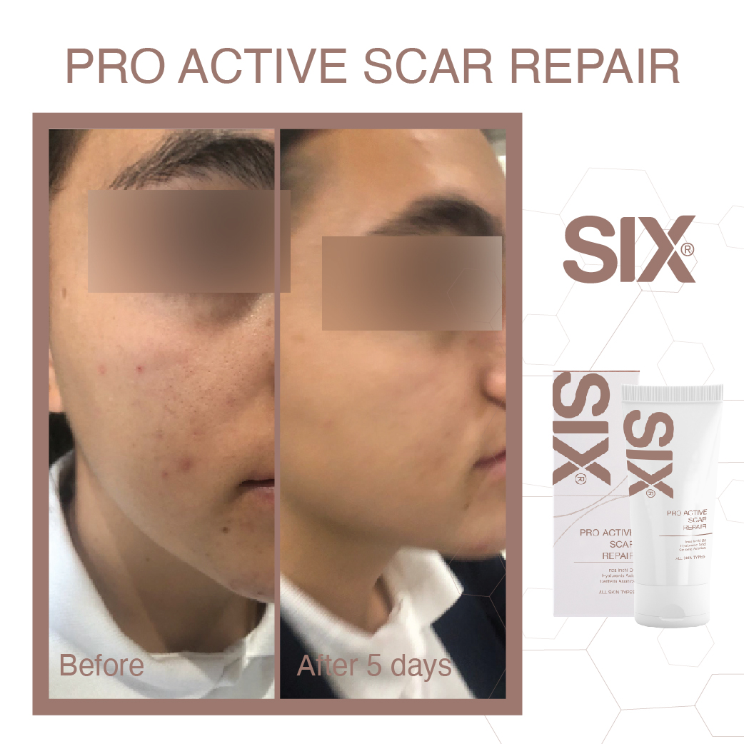 Before & After (Scar Repair)-01